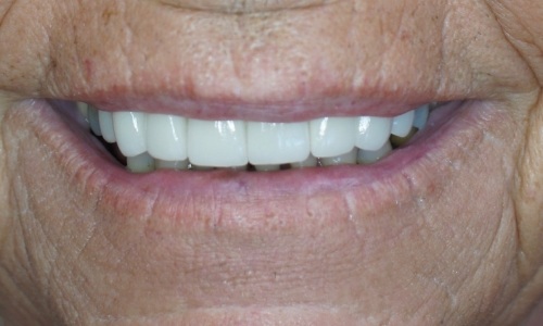 Smile after maxillary smile makeover