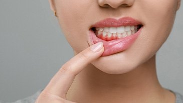 A woman revealing her inflamed gum tissue