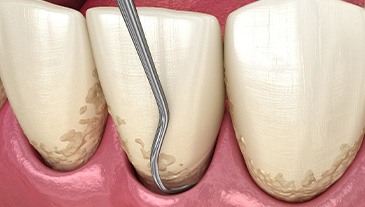 A 3D illustration of the scaling and root planing process