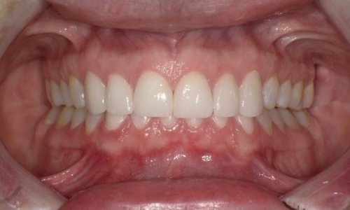 Closeup of smile after anterior veneer placement