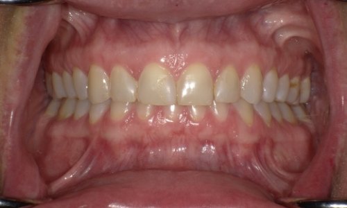 Closeup of smile before anterior veneer placement