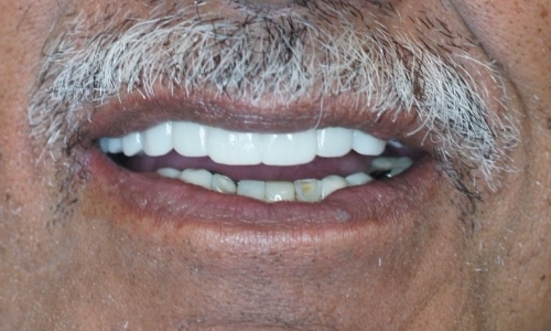 Closeup of smile after full arch on only dental implants