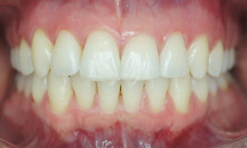 Smile after Invisalign treatment for anterior crowding