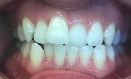 Smile before Invisalign to treat anterior crowding