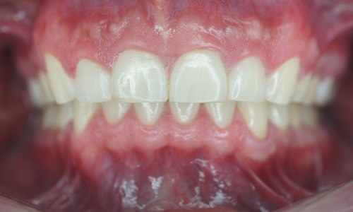 Smile after Invisalign treatment for diastema