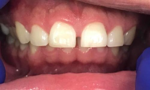 Smile before Invisalign treatment for diastema