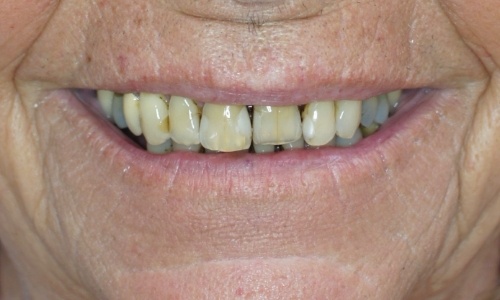 Smile before maxillary smile makeover