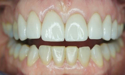 Smile after veneers smile makeover