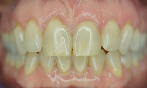 Smile before veneers smile makeover