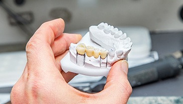 Dental bridge on a clay model