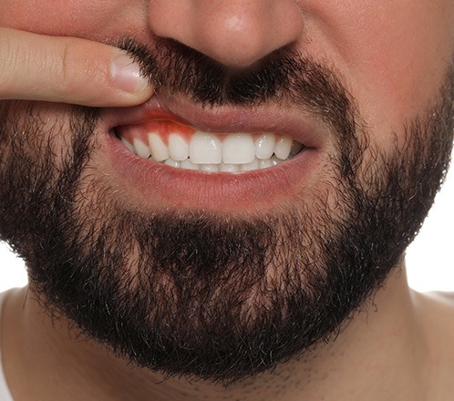 Man lifting his lip to show inflamed gums
