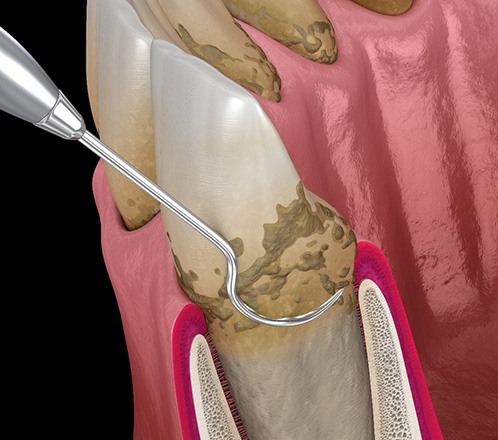 Illustration of dental scaler cleaning tooth roots