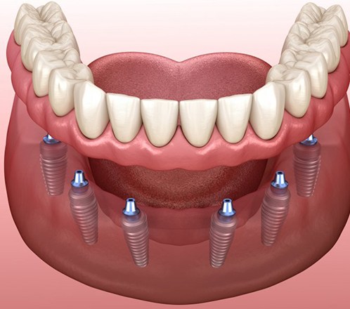 Illustration of implant dentures