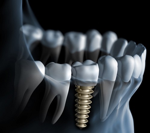 Digital illustration of an X-ray image of jawbone with dental implant in Lakeway