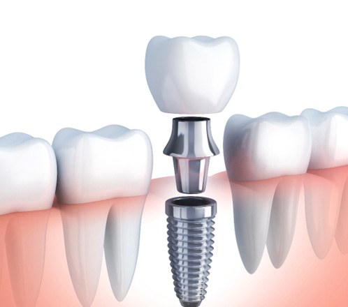 Digital illustration of a dental implant in Lakeway being inserted into a jawbone