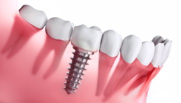 Digital illustration of a single tooth dental implant in Lakeway in a jawbone