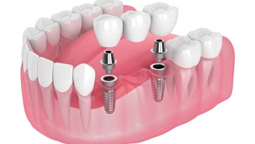 Digital illustration of an implant bridge in Lakeway being placed