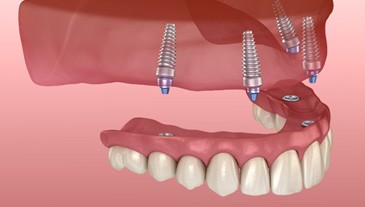 Digital illustration showing how implant dentures in Lakeway are placed