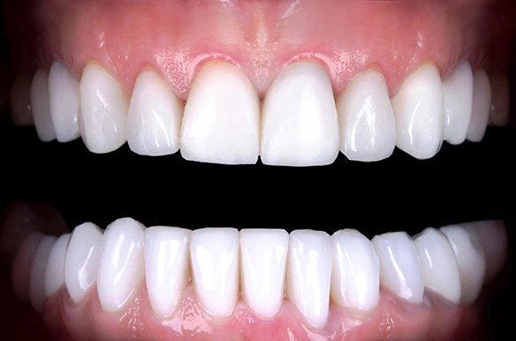 Closeup of bright smile after treatment from Lakeway dentist