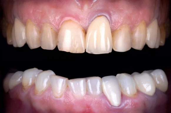 Closeup of discolored teeth before dental treatment in Lakeway Texas