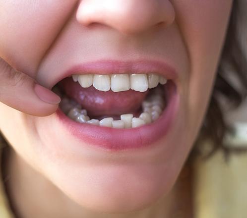 Closeup of smile undergoing Sure Smile treatment planning