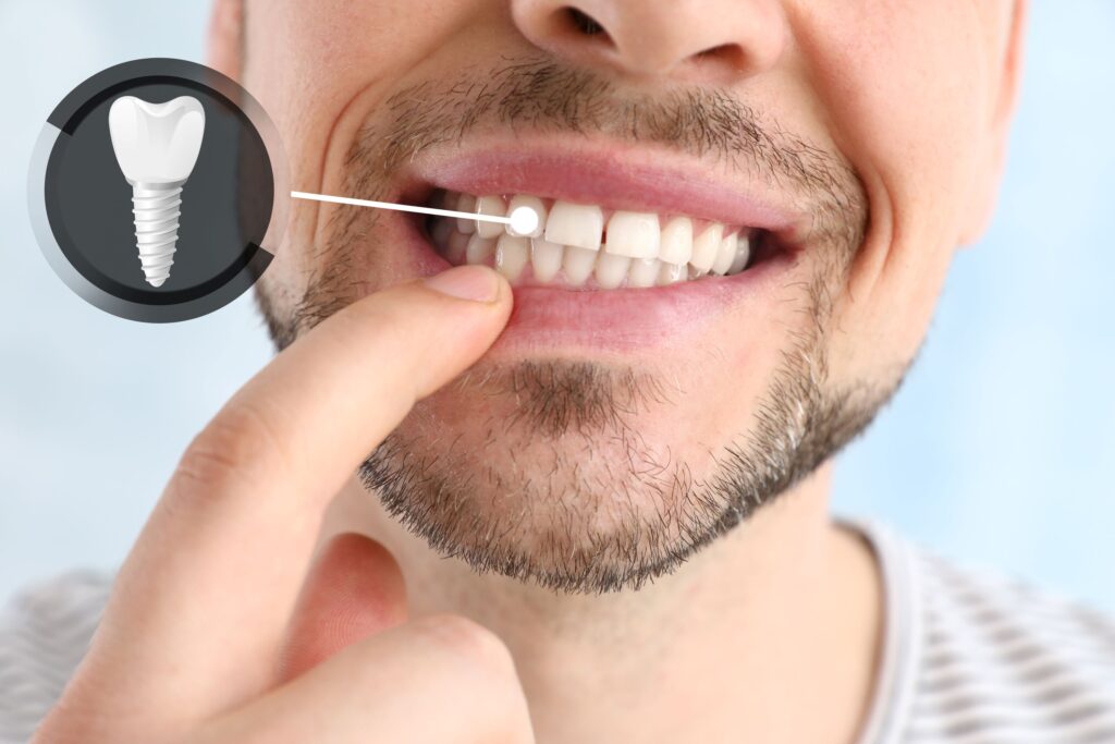 Nose-to-shoulder image of man touching tooth indicated as dental implant
