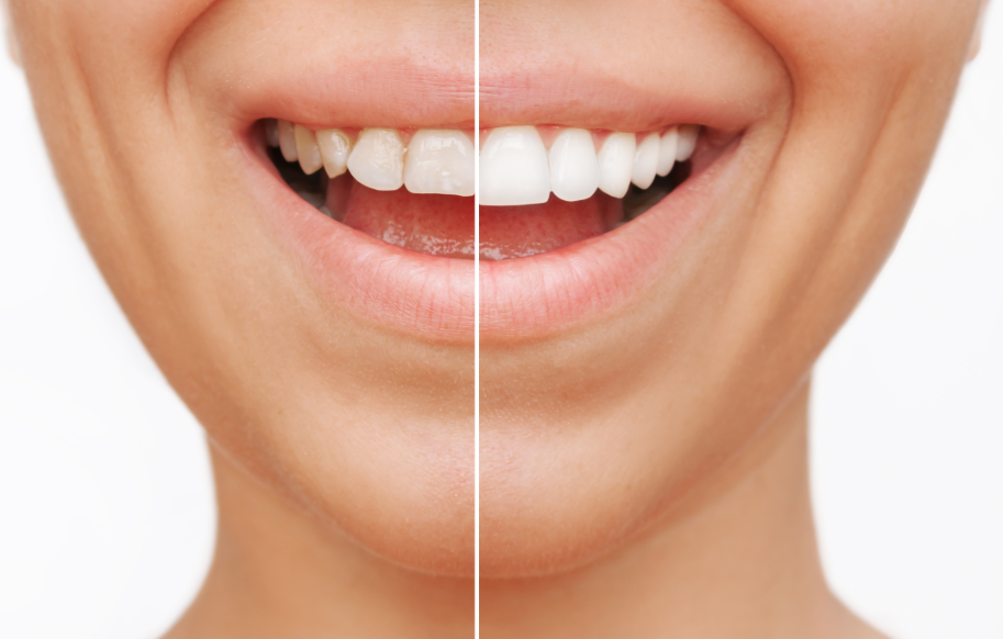 Woman's smile with half natural teeth, half veneers